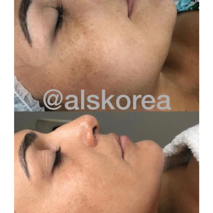 Paket BBGLOW Lengkap - Paket Dermapen MYM