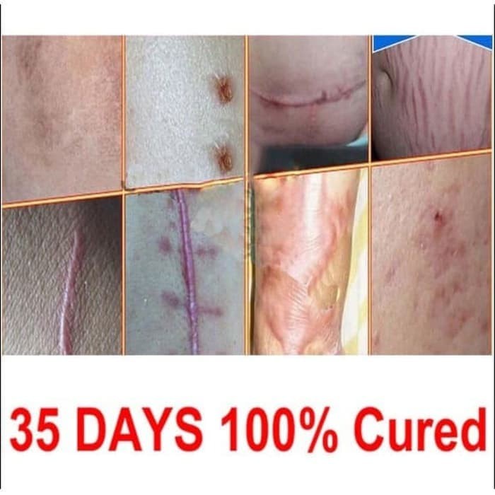 BAROKAH GAMIS Premium KELOID REMOVAL Scar burn Repair bekas operasi luka jatuh bakar