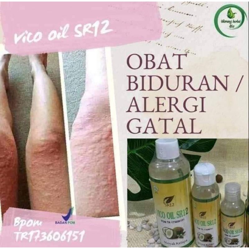 OBAT GATAL BIDURAN VICO SR12 PALING AMPUH/OBAT GATAL KULIT/OBAT BENTOL/OBAT ALERGI/VICO SR12 BISA DI