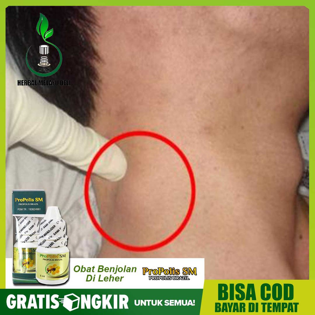 

OBat Herbal DI surabaya untuk benjolan radang, amandel radang tenggorokan PROPOLI SM bisa COD