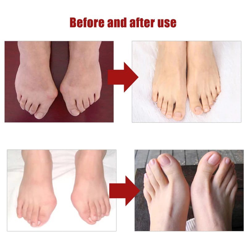 1 Pasang Insole Separator Thumb Silicone / Silikon Pelindung Jempol Kaki / Terapi Jari Kaki