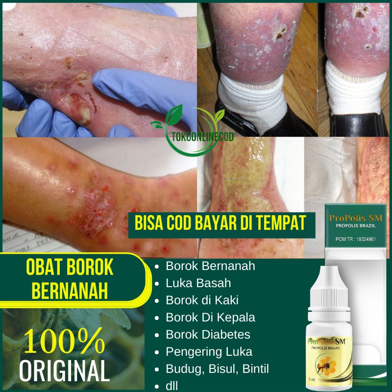 Obat Borok Bernanah Pengering Luka Basah Bernanah Salep Borok Bernanah Gatal Bernanah Psm Brazil Shopee Indonesia