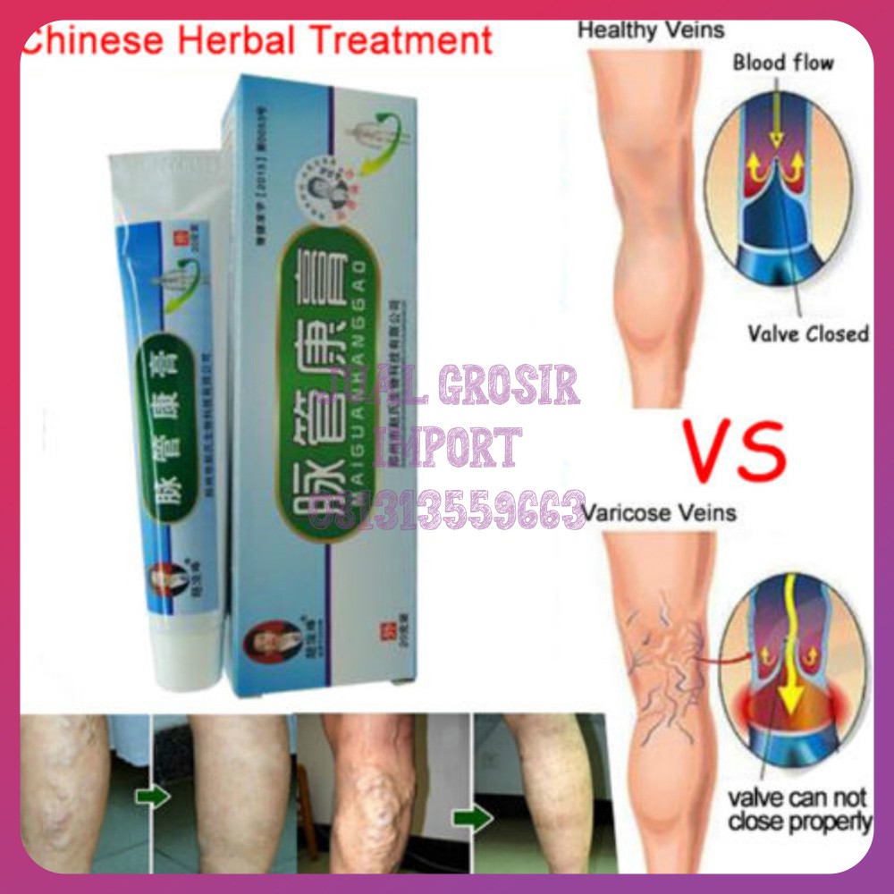 Obat varises Salep penghilang Varises Tanpa Operasi - Varicose Veins Treatment Cream