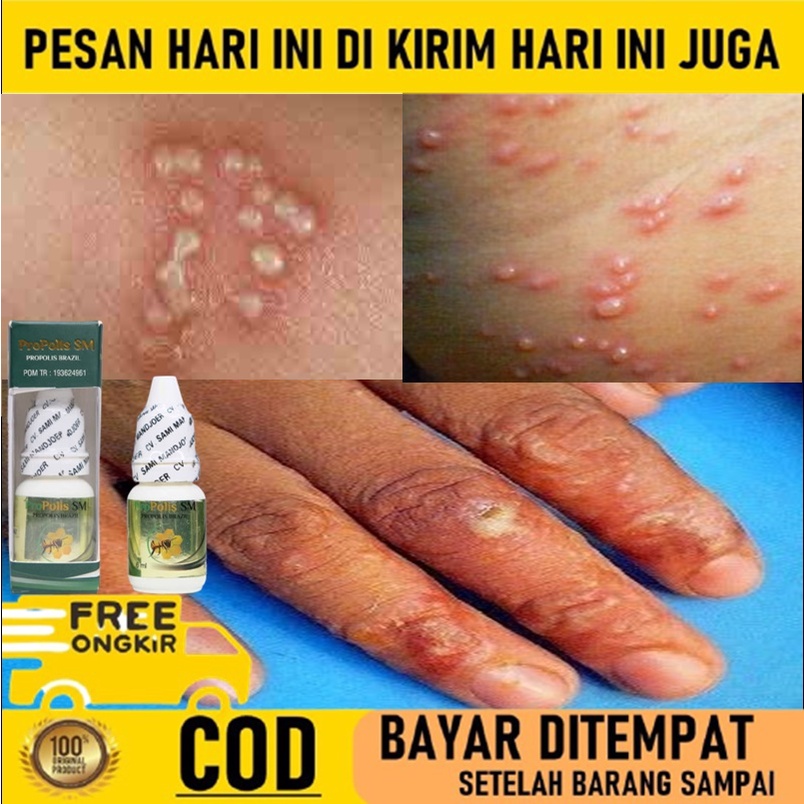 Salep budug -  - Obat Scabies manusia - Obat scabies / kudis - Salep scabies manusia - Obat gatal ja
