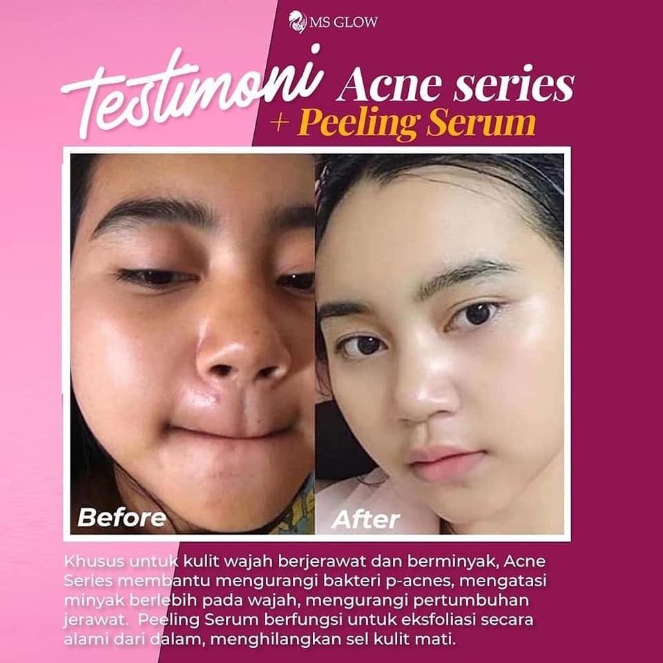 Ms Glow Serum Peling Original100% Ms Glow Exfoliating Serum Serum Eksfoliasi Peeling Serum