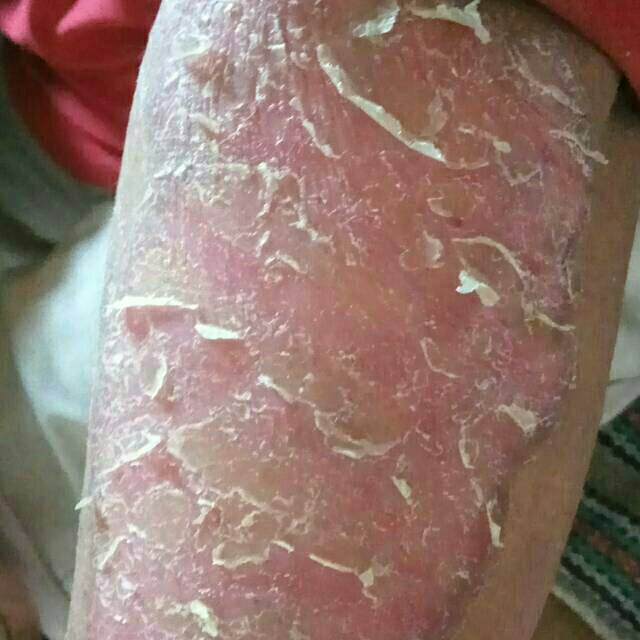 Obat gatal/ salep psoriasis/ racikan