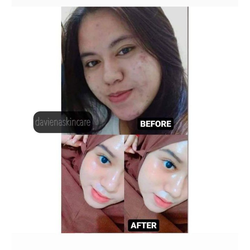 (DAVIENA OFFICIAL)DAVIENA SKINCARE|ACNE SERIES|CREAM JERAWAT AMPUH|SKINCARE|PAKET JERAWAT|PAKET ACNE|DAVINA SKINCARE