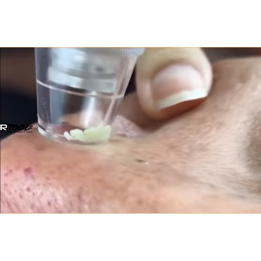 DIAMOND PEELING MICRODERMABRATION - BLACKHEAD REMOVER- PENYEDOT KOMEDO - VACUUM BLACKHEAD KOMEDO