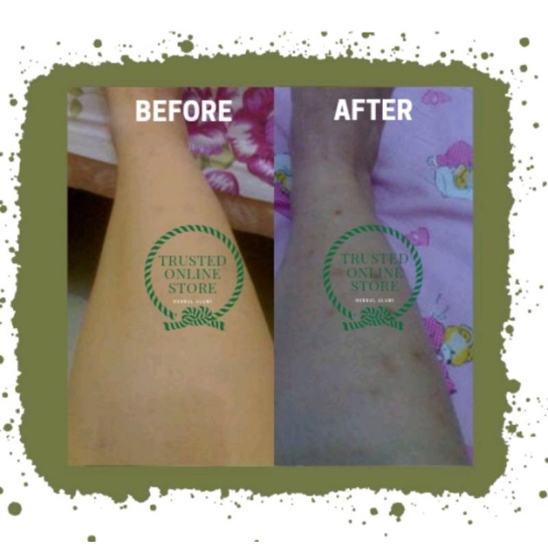 VITASOFTOIL ORIGINAL VITA OIL VITASOFT OIL PENGHILANG KELOID BEKAS LUKA BOPENG