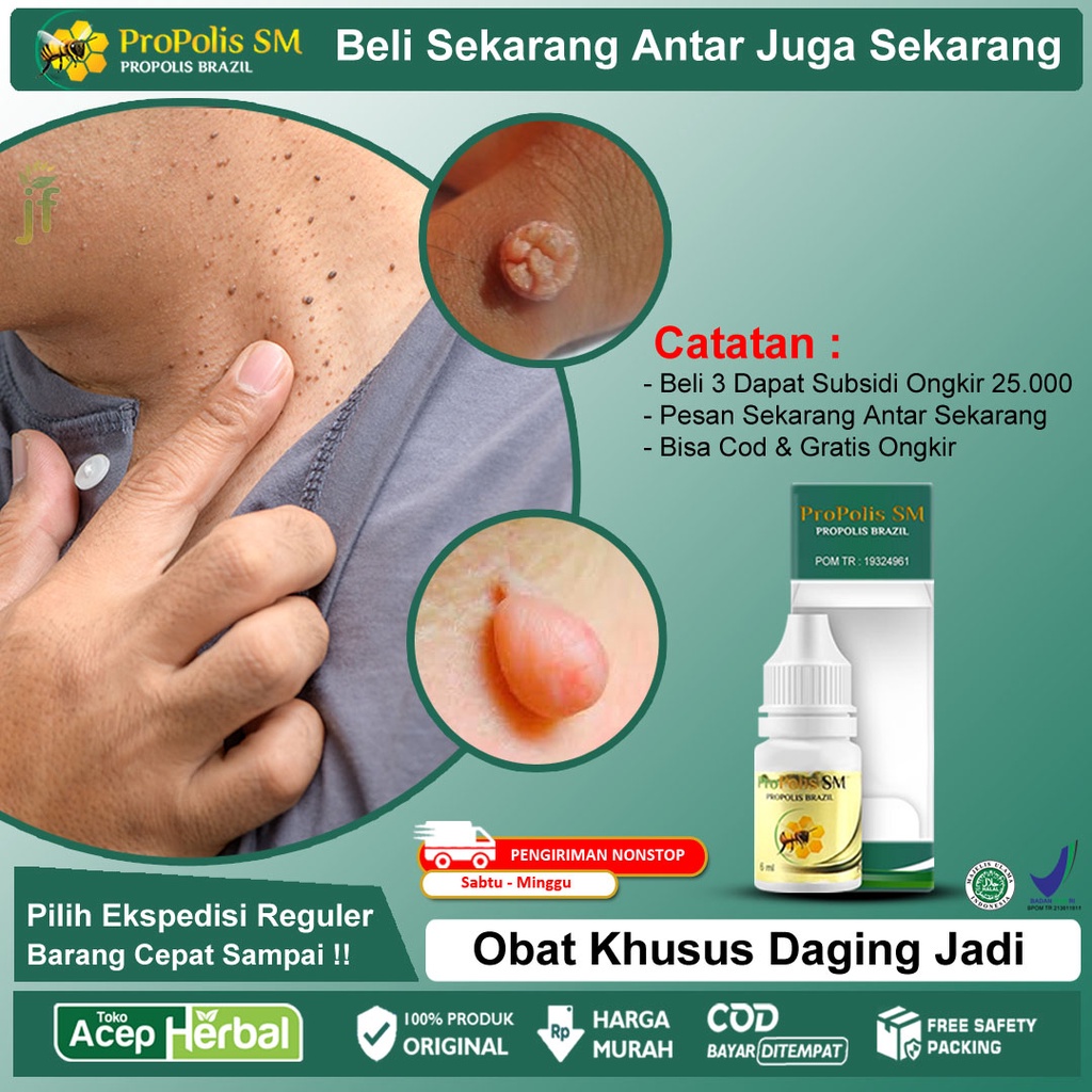 Obat Herbal Daging Jadi, Kutil Kelamin, Papiloma, Keloid, Milia, Ganglion, Skin Tag, Parasit, Mata Ikan, Kelenjar Getah Bening, Jerawat Bopeng, Benjolan di Tubuh, Kapalan, Uci uci, Fibroid - PROPOLIS SM BRAZILIAN 100% ORIGINAL BPOM