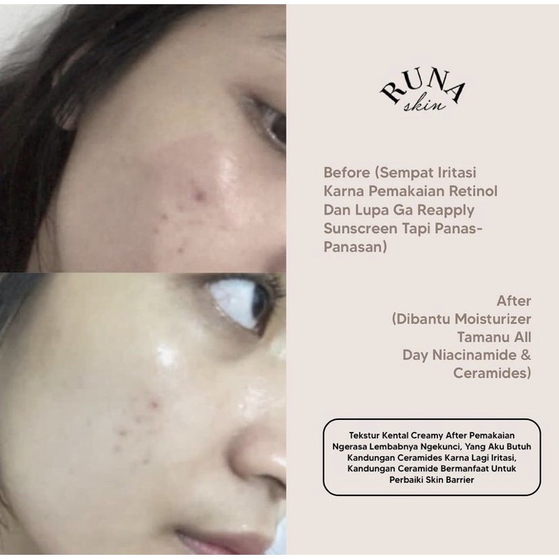 Runaskin Acne Combat Cream Totol Jerawat dan Bekas