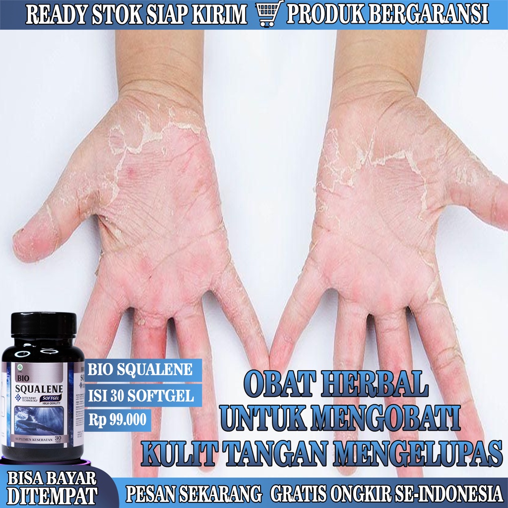 Obat Kulit Telapak Tangan Kering, Kulit Tangan Kering Dan Pecah - Pecah, Berisik, Keriput, Mengelupa
