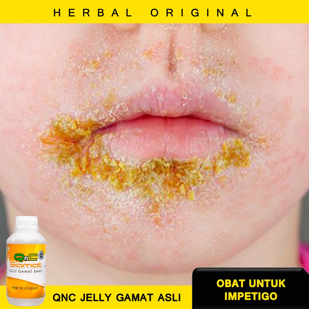 Obat Impetigo Alami