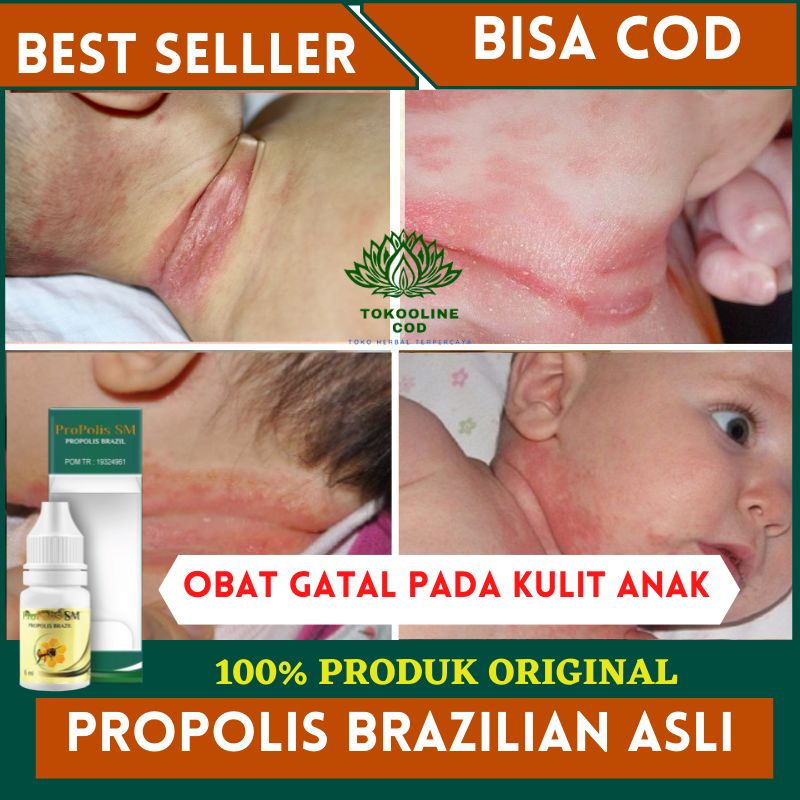 Obat Gatal Anak Pada Kulit, Biang Keringat, Bruntusan, Ruam Popok, Ruam Leher & Selangkangan Bayi PR
