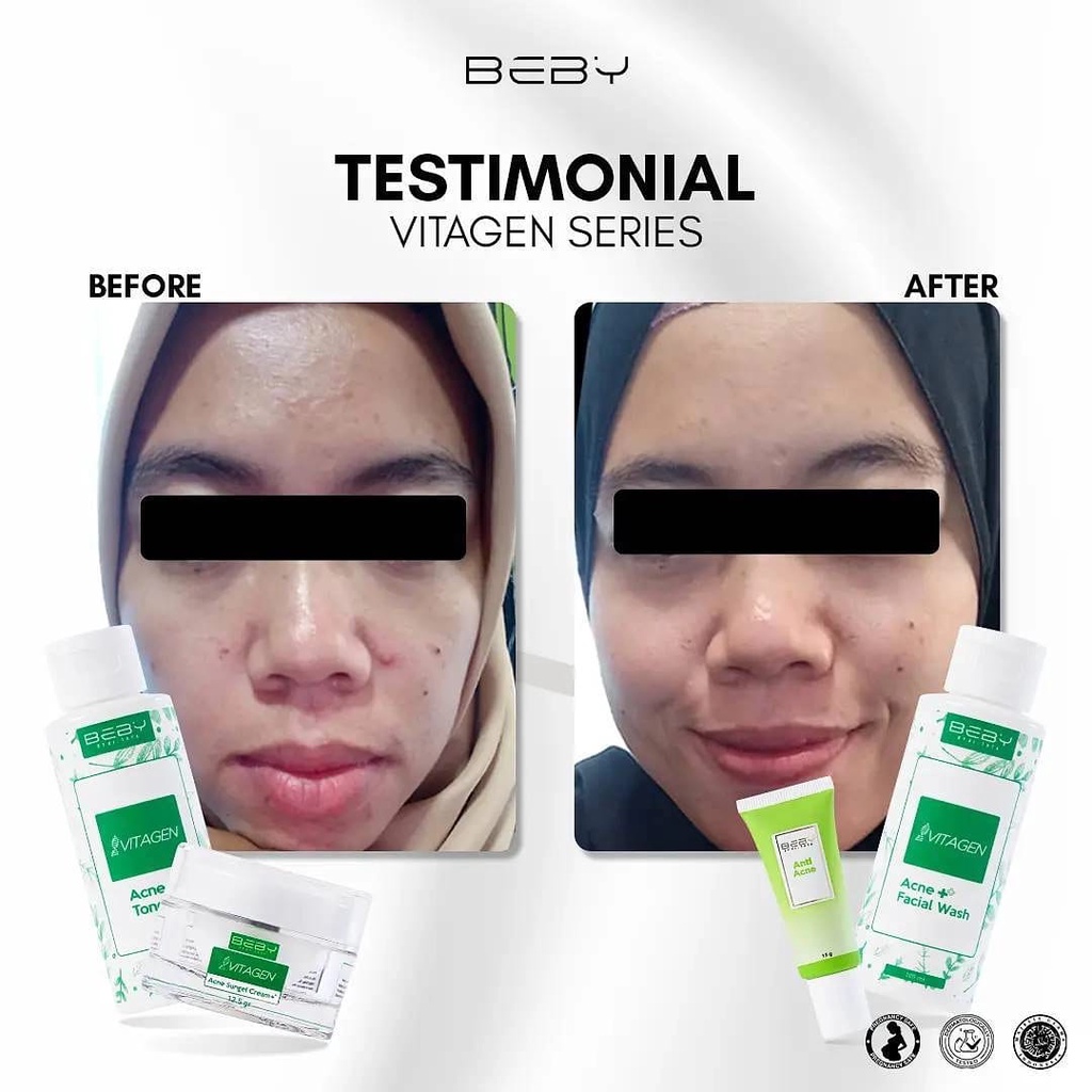 ANTI ACNE GEL SPOT BEBY (TOTOL JERAWAT)