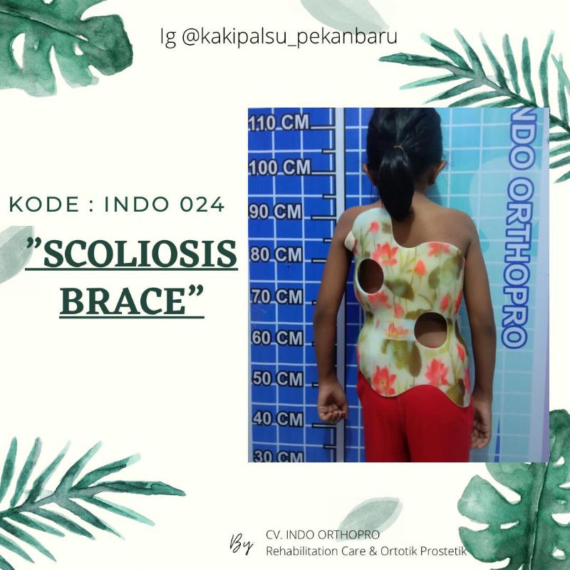 Brace scoliosis / korset skoliosis / scoliosis