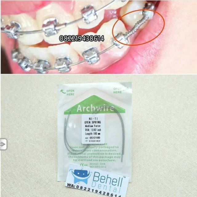 HIGH QUALITY KAWAT NITI OPEN COIL SPRING FDA OCS // Wire Dental Ortho Bracket Behel Gigi Orthodontic Koil Per Pegas // Untuk Merapatkan Ruang Gigi Original