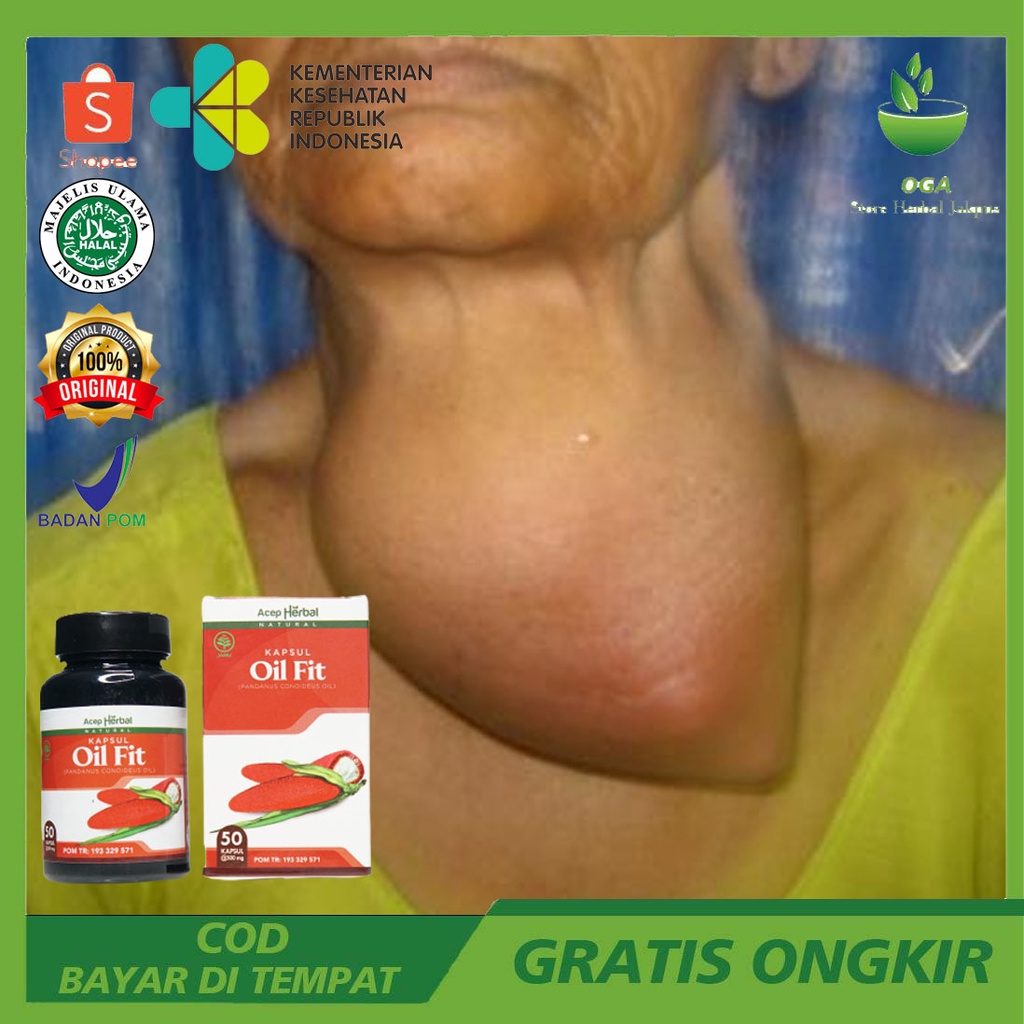 Obat herbal kelenjar tiroid gondok hipertiroid hipotiroid benjolan di leher herbal