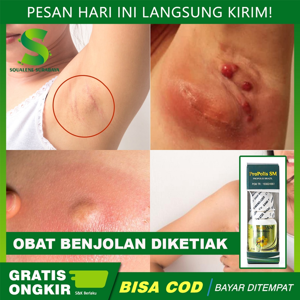 Jual Propolis Sm Herbal Alami Cod Obat Benjolan Diketiak Benjolan