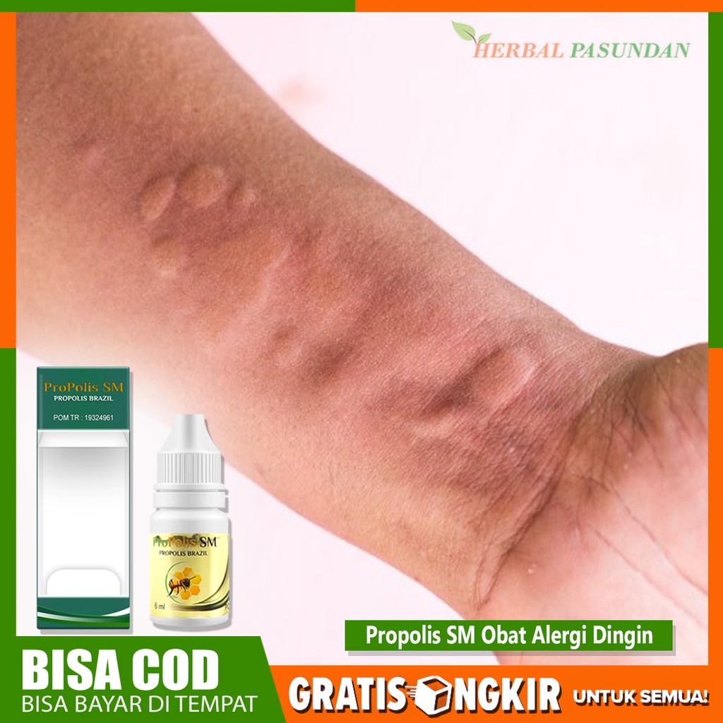 Obat alergi dingin, alergi flu, alergi gatal gatal, alergi kulit, jamur Propolis SM Brazzilian