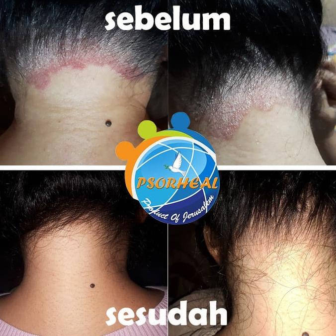 Paket Cream TANPA SHAMPO Ketombe Parah Psoriasis SCALP PSORHEAL ISRAEL