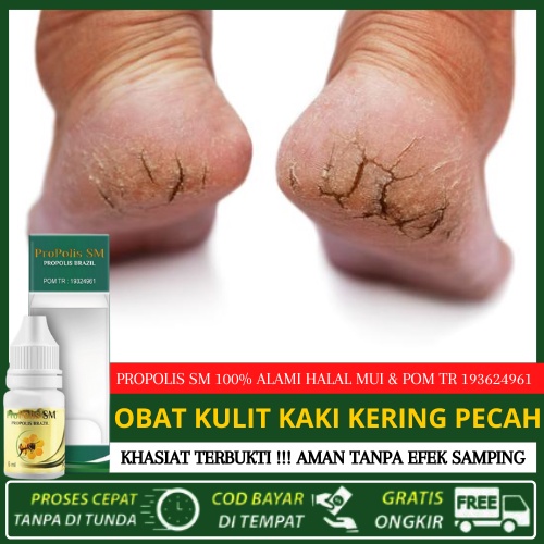 Obat Kulit Kaki Kering Dan Pecah Kulit Kaki Bersisik Kering Mengelupas Gatal Di Kaki Koreng | PROPOL