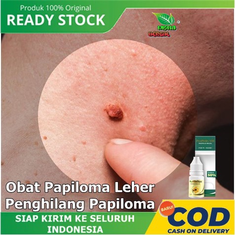 Obat Papiloma Obat Papiloma Leher Obat Penghilang Papiloma Herbal Penghilang Kutil Obat Penghilang T