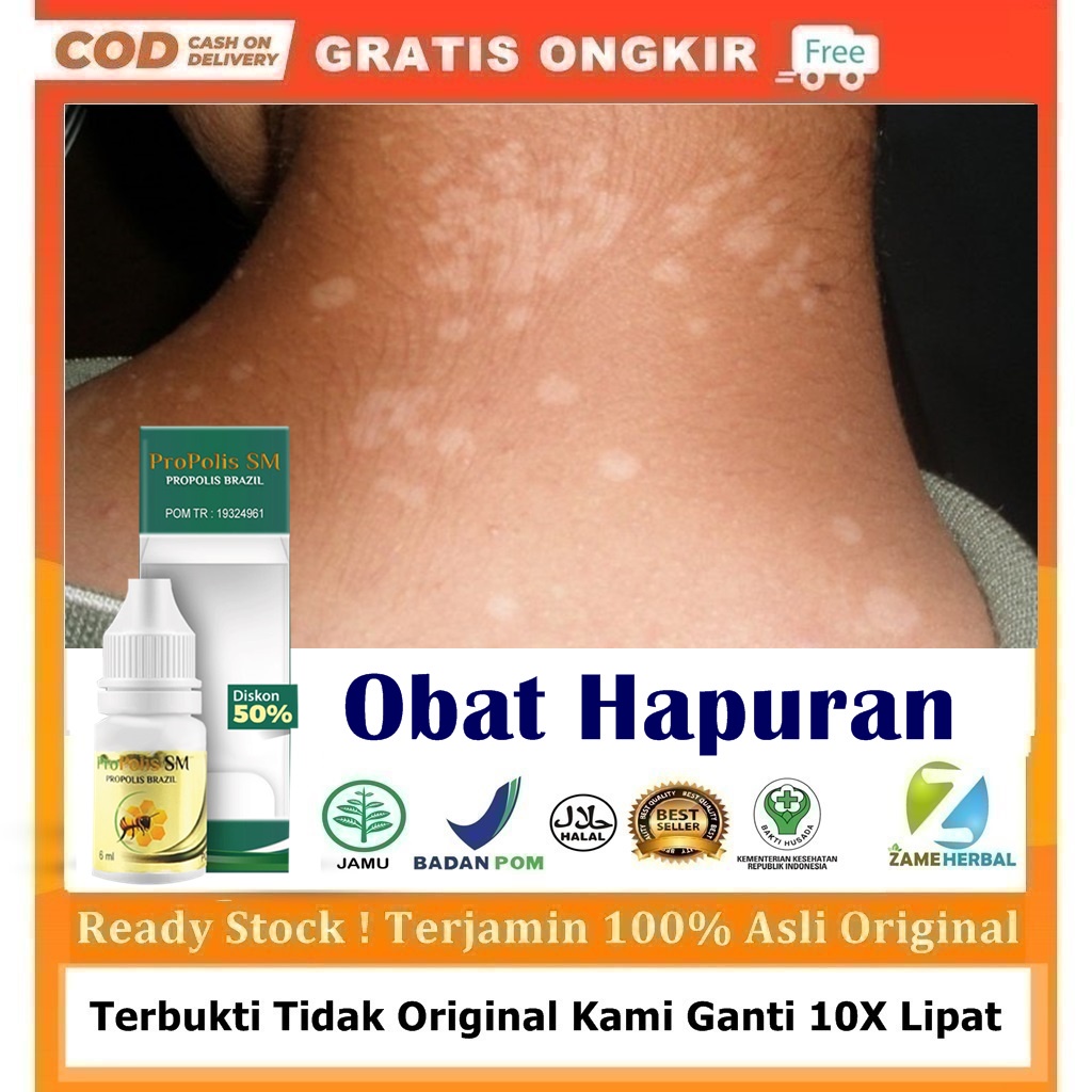 Obat Hapuran, Penghilang Bercak Putih Di Kulit, Hapur, Balas Bogo, Panu, Bercak Putih Di Wajah, Pung
