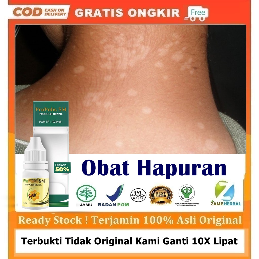 Jual Obat Hapuran Penghilang Bercak Putih Di Kulit Hapur Balas Bogo Panu Bercak Putih Di