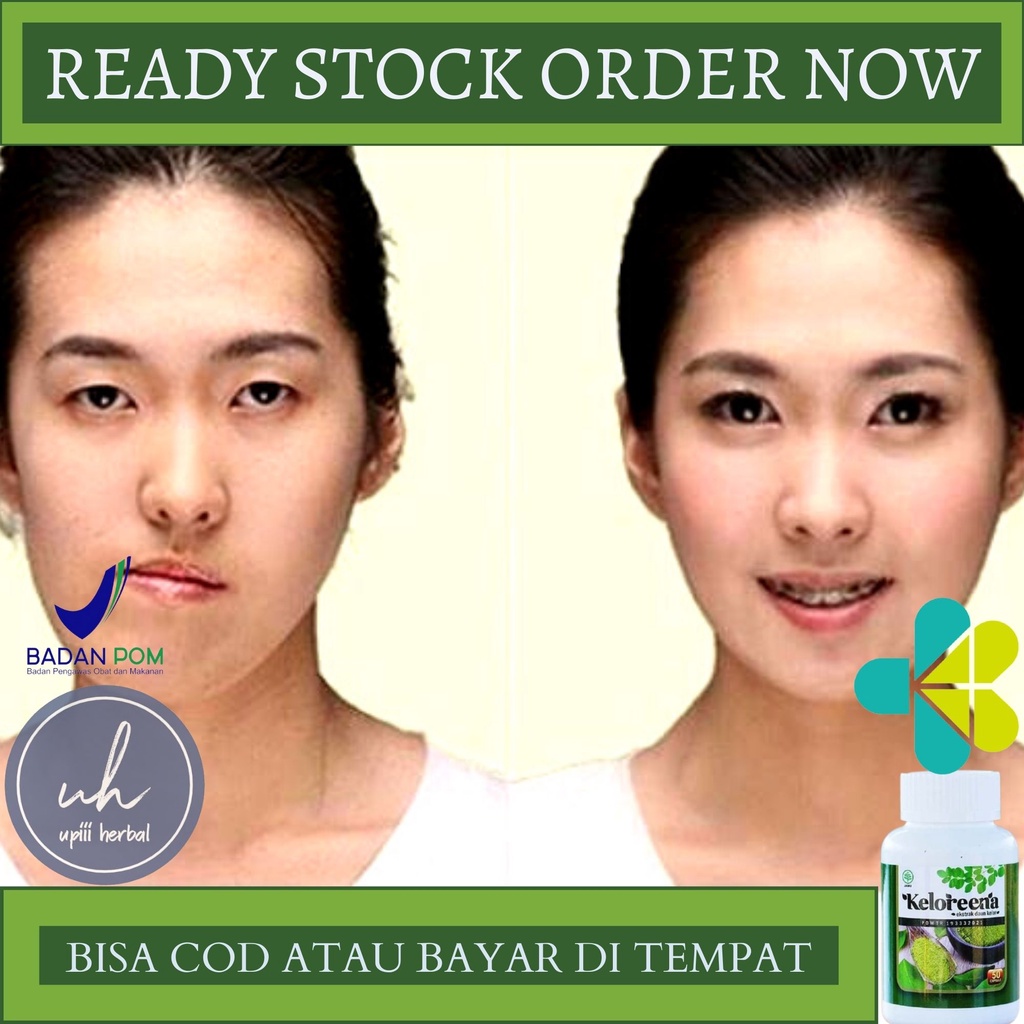 Obat Wajah Tidak Simetris, Obat Untuk Wajah Tidak Simetris, Obat Rahang Geser, Obat Cedera Rahang, O