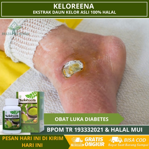 Obat Luka Diabetes Basah, Pengering Luka di Kaki, Obat Luka Bernanah, Gangren Cepat Kering, Luka Bor