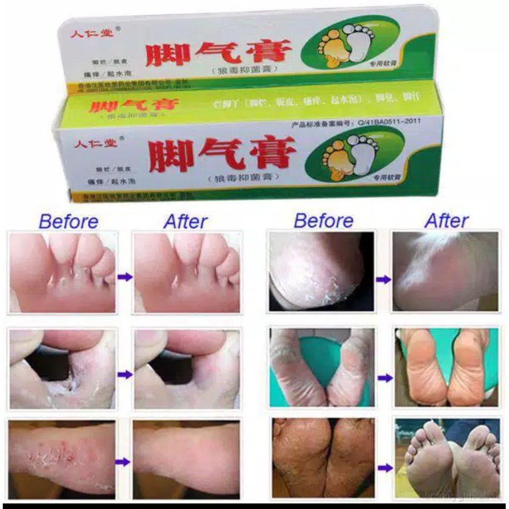 OBAT KUTU AIR RAYAPAN RANGEN KAKI KAPALAN PECAH PECAH