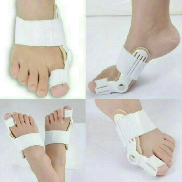 Hallux Valgus Bunion