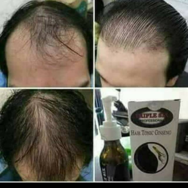 Penumbuh rambut 2987