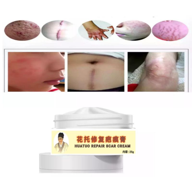 cream bekas luka keloid huatuo