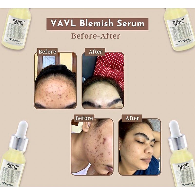 VIGHTNE BLEMISH SERUM ORIGINAL [ BPOM ]