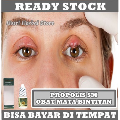 Obat Mata Bintitan - Obat Bintitan di Bawah Mata, Obat Kalazion, Obat Bintitan mata, Obat Bintitan Salep, Obat Mata Bintitan Alami, Obat Mata Bengkak, Obat Sakit Mata Bintitan, Obat Benjolan di Kelopak Mata Dengan Herbal Propolis SM 100% Original