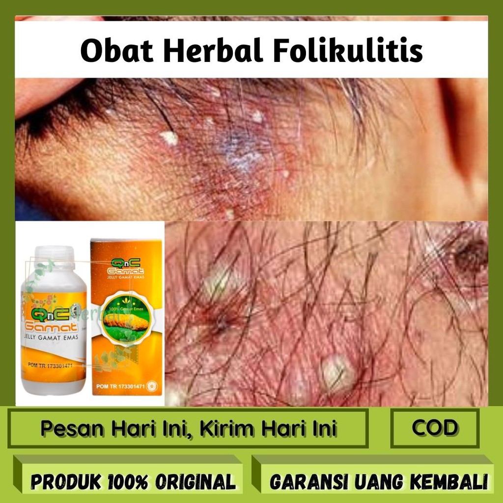 Jual Obat Folikulitis Obat Benjolan Pada Kulit Rambut Obat Benjolan Bernanah Qnc Jelly Gamat 