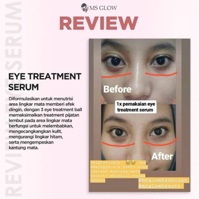 Eye Cream Ms Glow Serum Mata Mengatasi Kantung Mata Kerutan Dan Mata Hitam 15gr Shopee Indonesia