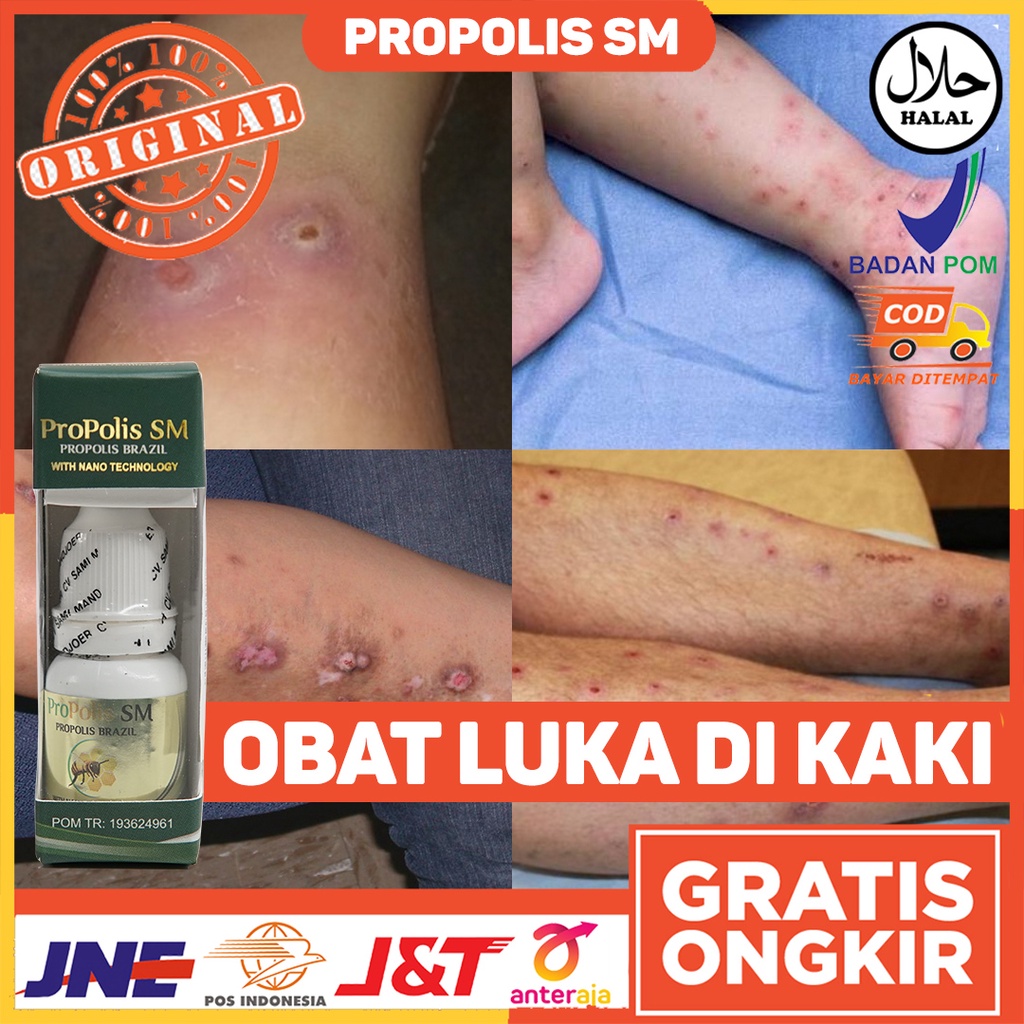 Jual Obat Luka Di Kaki Obat Luka Bernanah Obat Luka Berdarah Obat