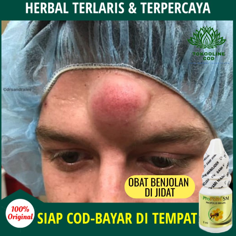 Obat Benjolan di Jidat, Benjolan di Dahi, Benjolan di Kening, Benjolan di Kepala, Tumor, Lipoma COD