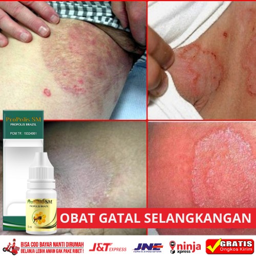 Obat Gatal Selangkangan, Obat Penghilang Gatal Selangkangan, Obat Oles Gatal Selangkangan | Propolis