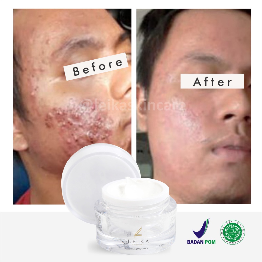 Krim Siang Penghilang Bekas Jerawat Ampuh BPOM Obat Penghilang Bekas Jerawat Pria Membandel Aman BPOM Penghilang Bekas Jerawat Penghilang Bopeng Bekas Jerawat Cream Penghilang Bekas Jerawat Day Cream Leika Skincare Penghilang Bekas Jerawat Pria Pembersi