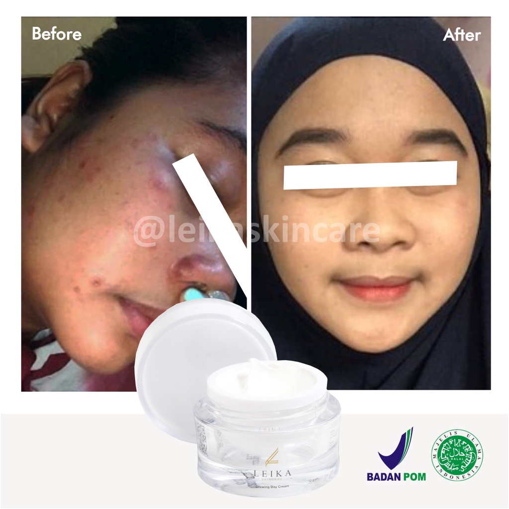 Krim Wajah Penghilang Bekas Luka Jerawat Asli 100% Ampuh! Penghilang Bekas Jerawat Bopeng Cepat BPOM Halal MUI Penghilang Bekas Jerawat Menghitam Glowing Day Cream Leika Skincare 10gr Original