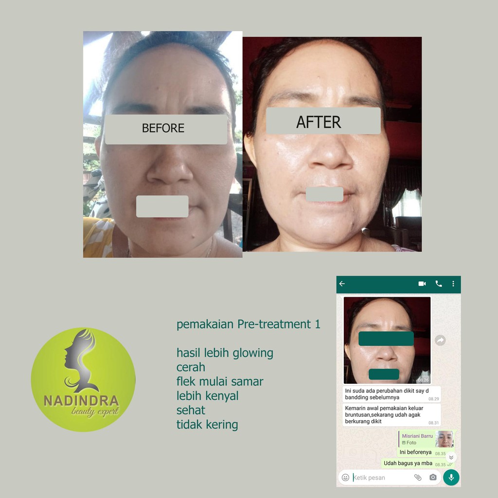 Nadindra Beauty Expert paket Pre Treatment Acne - step 1 / netralisir efek samping skincare keras-2