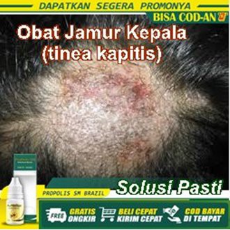 Obat Gatal Jamur di Kulit Kepala, Obat Jamur Kepala Menahun (penyakit tinea kapitis) - Propolis SM