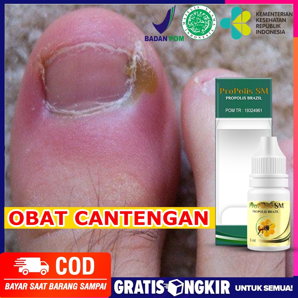 Jual Obat Cantengan Jempol Kaki Obat Kuku Cantengan Obat Tetes