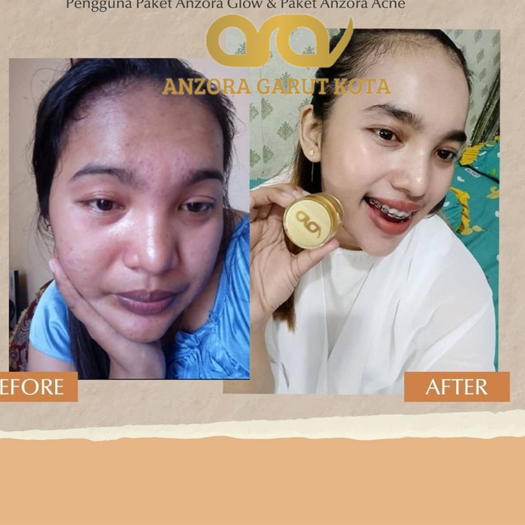 ANZORA ANZORA SKINCARE ANZORA SKINCARE GLOWING ANZORA ACNE ANZORA ACNE DARK SPORT ANZORA SKINCARE ORIGINAL SKINCARE ACNE SKINCARE KECANTIKAN PERAWATAN WAJAH PERAWATAN WAJAH ANZORA BODY LOTION SKINCARE GLOWING SKINCARE WAJAH BERJERAWAT  ANZORA GARUT KOTA-4