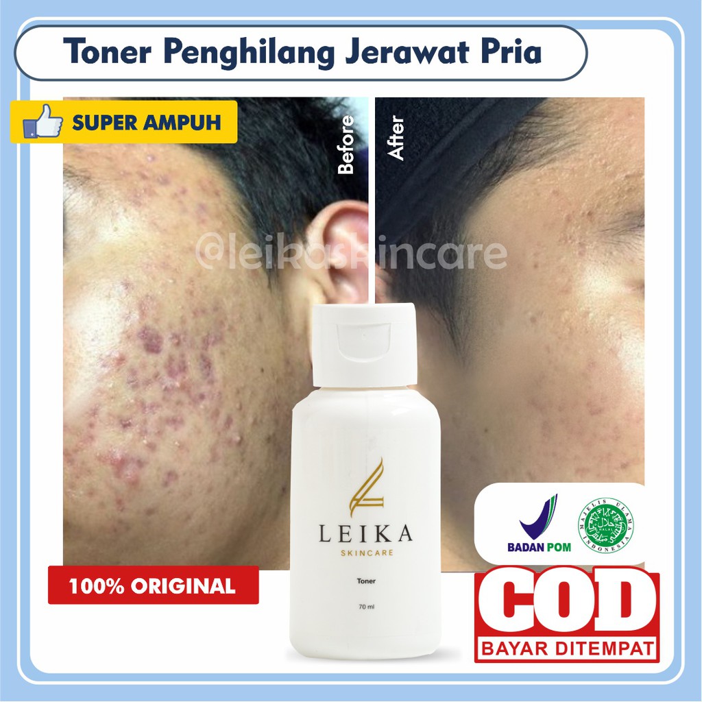 Toner Acne Penghilang Jerawat Dan Bruntusan Penghilang Jerawat Pria Toner Jerawat Dan Bruntusan Meng
