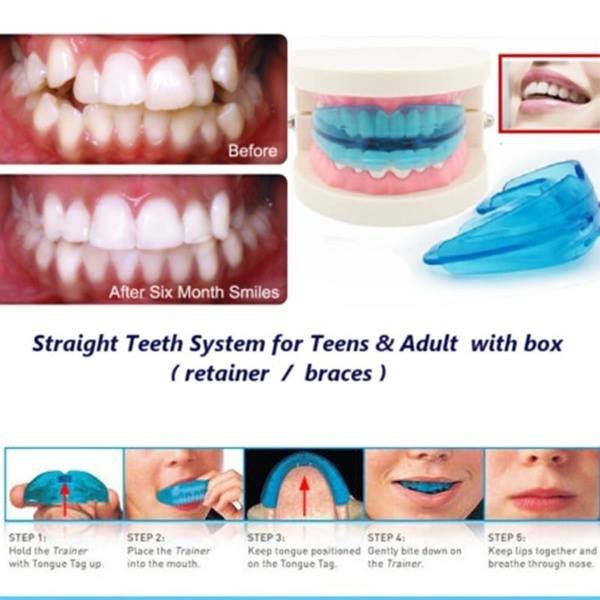 [BIRU] Perapi Gigi Tanpa Behel dari Bahan Silikon Bukan Kawat l Orthodentic Retainer Teeth Phase 1